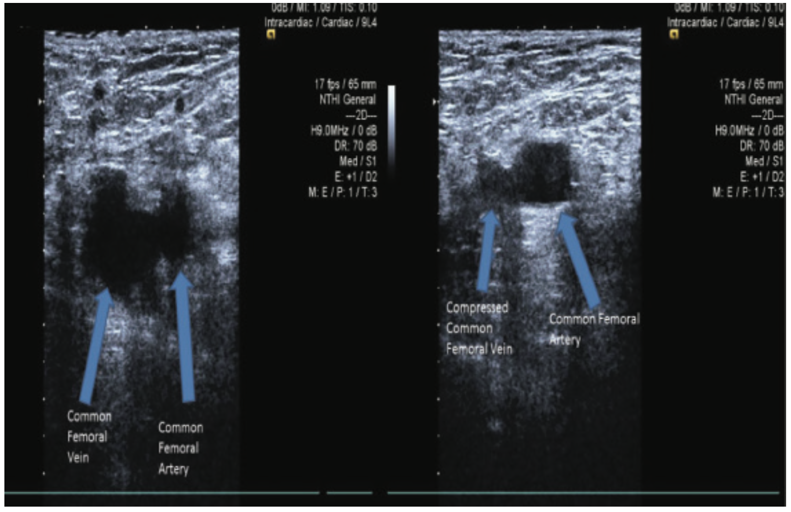 UltrasoundGuided Vascular Access Routes An Overview